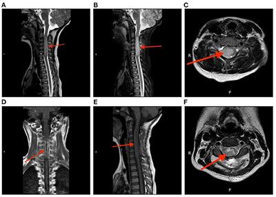 Spinal Cord Diffuse Midline Glioma With Histone H3 K27M Mutation in a Pediatric Patient